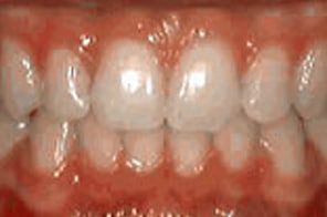 Corrected bite with balanced alignment of upper and lower teeth.