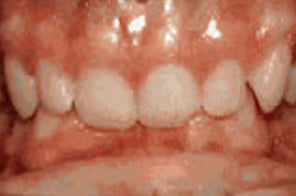 Severe deep overbite with lower teeth overlapping into the palate.