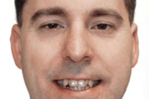 Man smiling showing teeth before orthodontic treatment at Elvebak Orthodontics.