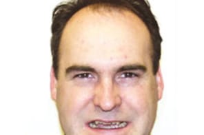 Before treatment – adult with misaligned and overlapping teeth.