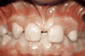 Gaps where lateral incisors are missing in the upper jaw.