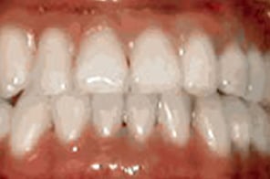 Corrected bite with upper and lower teeth aligned properly.