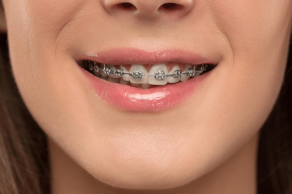 How Braces Can Improve Your Bite and Oral Health