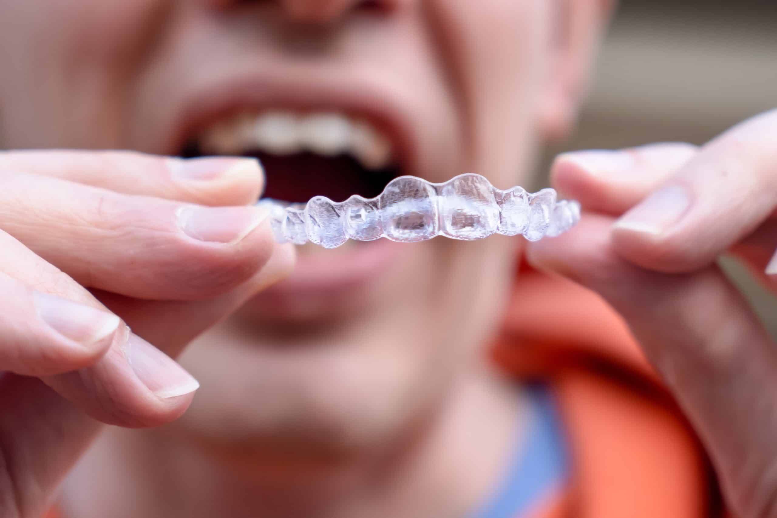 Lost an Aligner Tray? Here’s What to Do Next