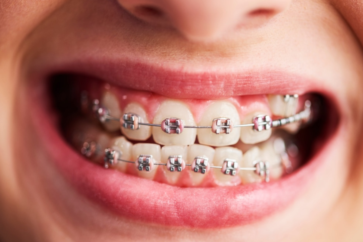 Why Teeth Shift After Braces Are Removed